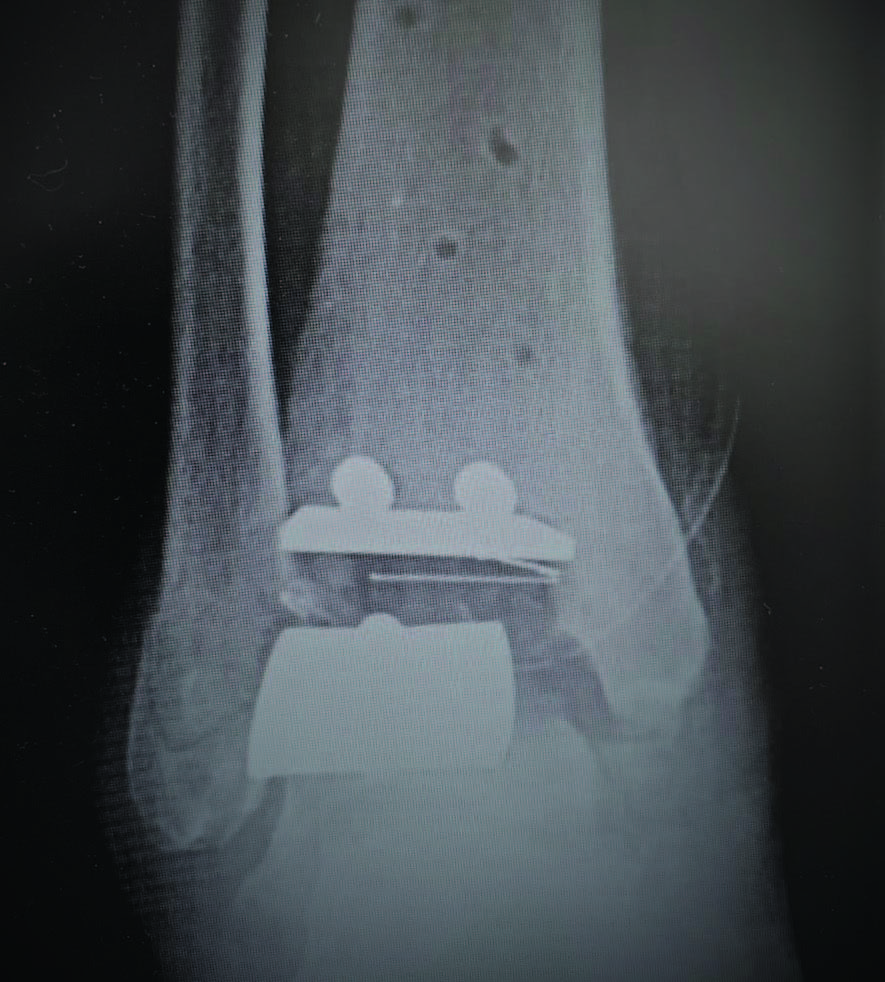 Addressing Impingement Issues After Total Ankle Replacement