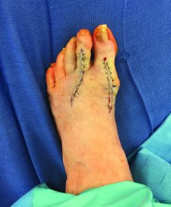 plantar plate tear repair
