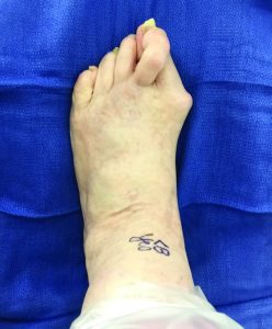 Plantar Plate Tears