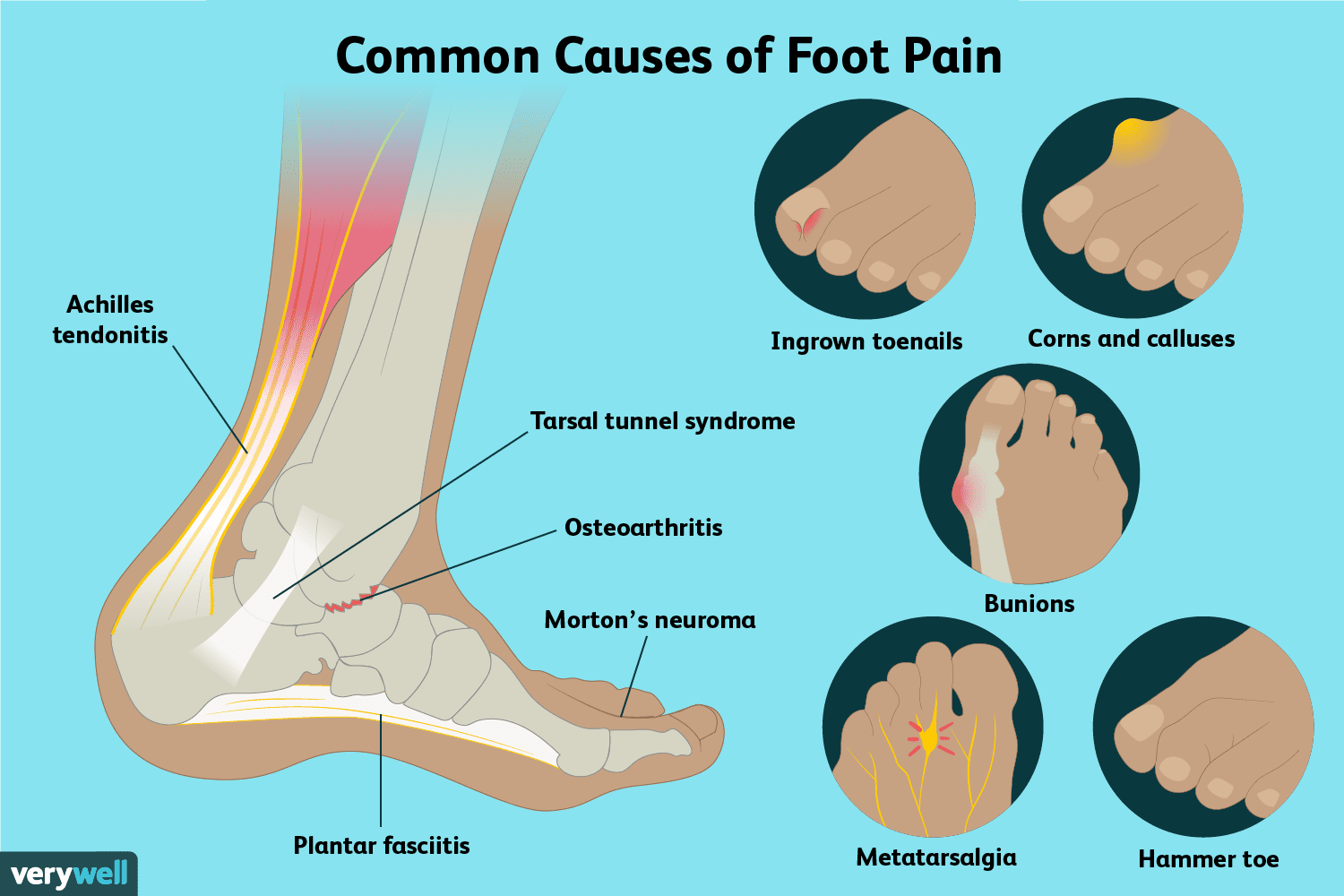 Why Are My Feet Swollen And Hurt When I Walk