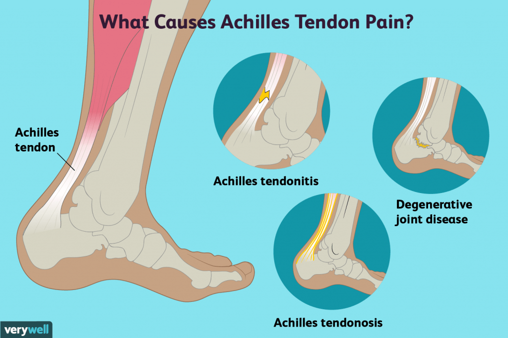 achilles-tendon-pain-orsaker-behandling-och-när-man-ska-se-a-5251