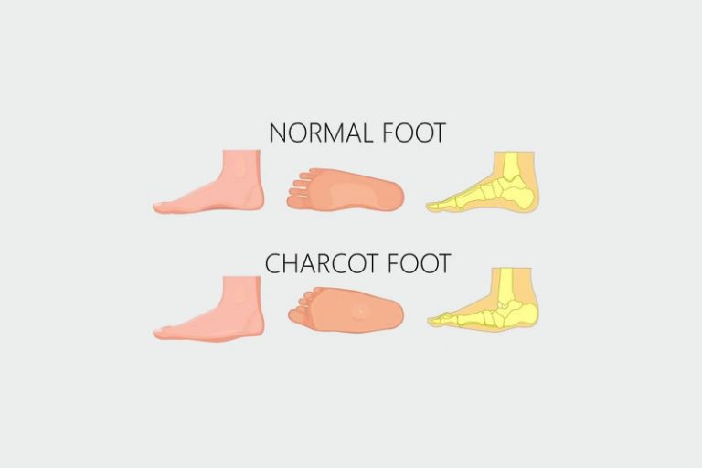 Charcot Foot Dr. Babajide A. Ogunlana, DPM, FACFAS Wes