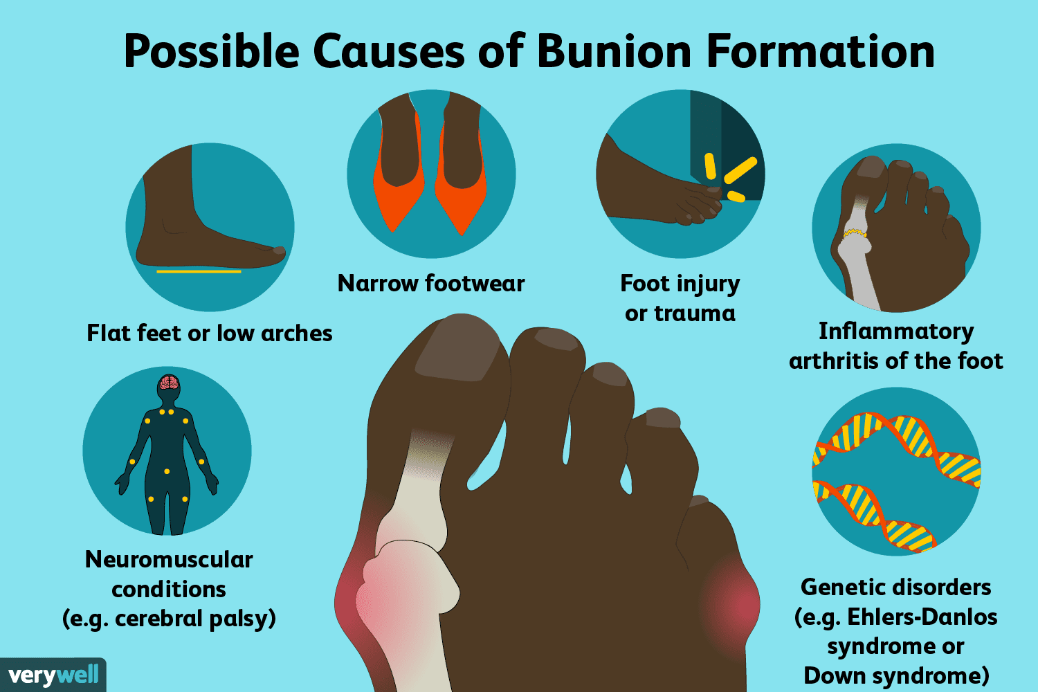 Bunions